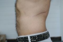 scar-kidney-transplant-625242-m